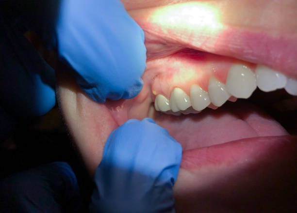 Best Emergency Dentist for Lost Fillings or Crowns in Colquitt, GA